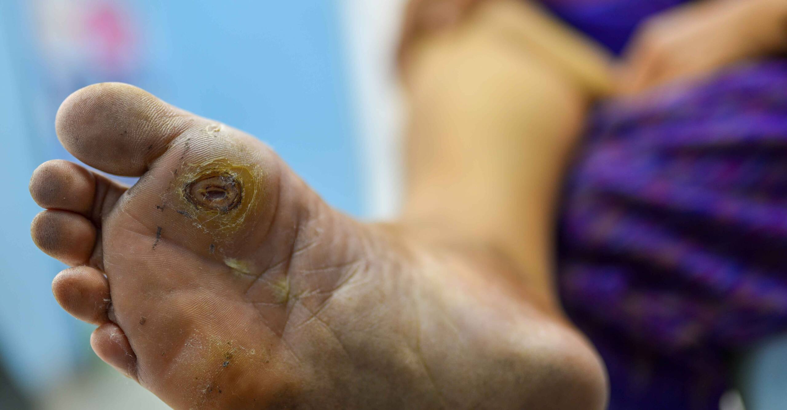 Diabetic Foot Ulcers